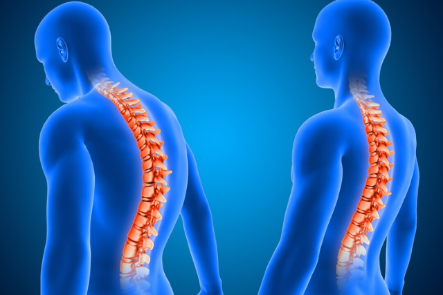 Understanding Kyphosis (1)