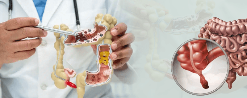 Understanding Appendectomy Surgery: A Complete Guide