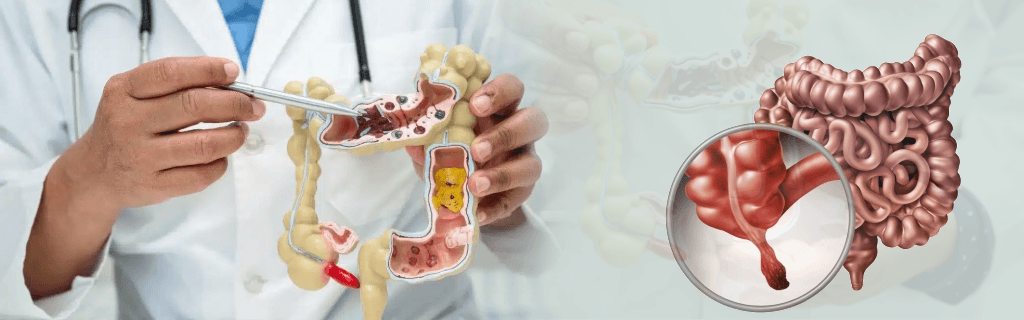Understanding Appendectomy Surgery: A Complete Guide