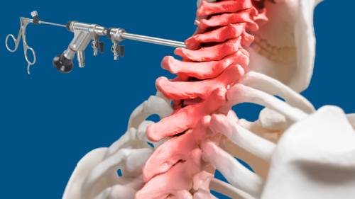 Full Endoscopic Cervical Disectomy