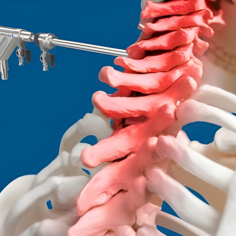 Disc Compression Treatment