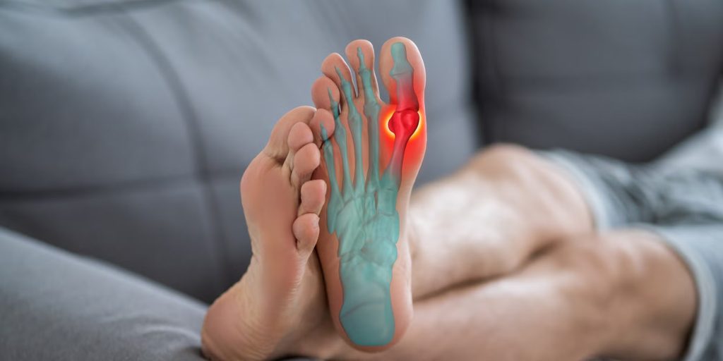 Hallux Rigidus