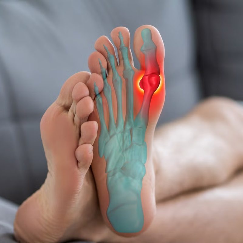 Hallux Rigidus