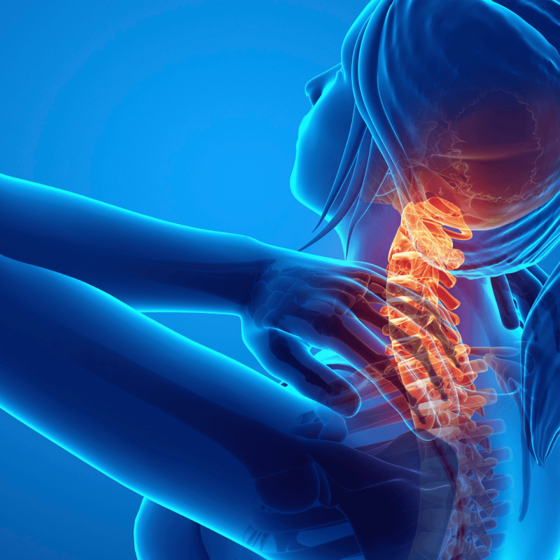Cervical Disc Herniation
