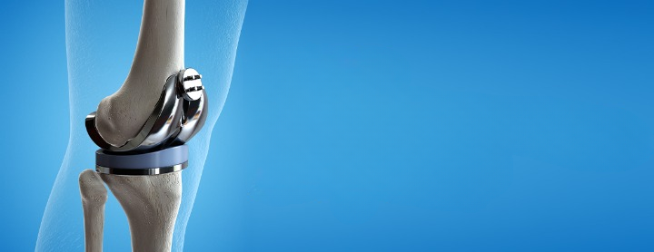 Knee replacement surgery abroad