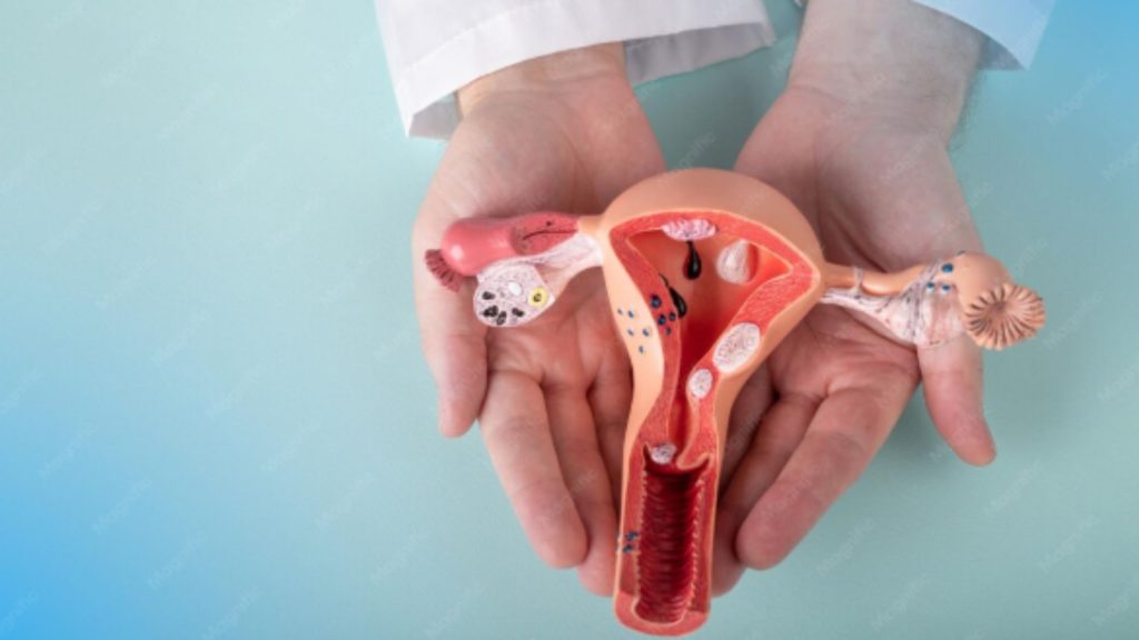 Endometriosis