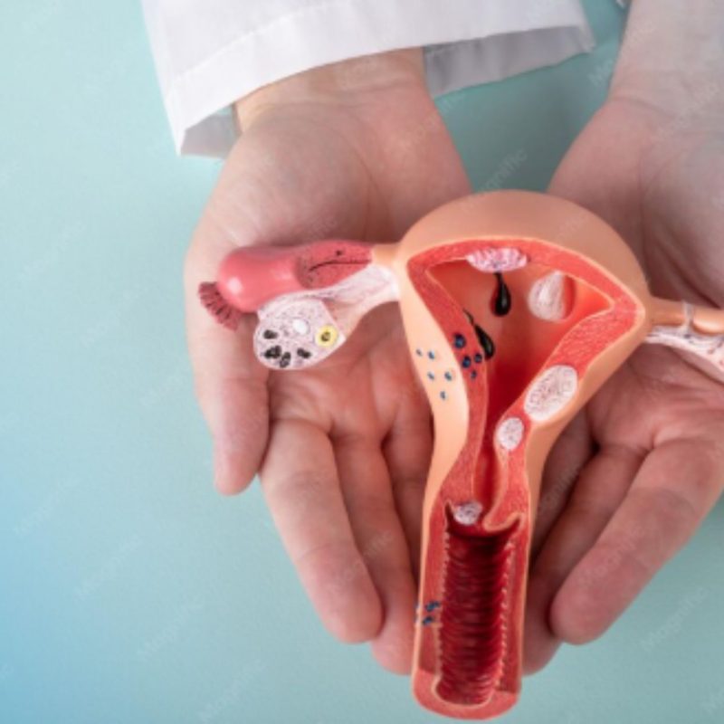 Endometriosis